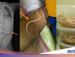 Bocah 3 Tahun Di Jember Mengeluh Susah BAB, Ternyata Ususnya Dipenuhi Cacing