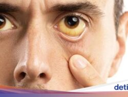 5 Cara Memutihkan Bola Mata yang Kuning Secara Alami