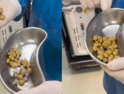 Sederet Tindak Kejahatan Medis ‘Batu’ Di Tubuh Pasien, Ada Di Ginjal hingga Miss V