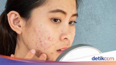 Batasi Konsumsinya! 7 Konsumsi Pemicu Jerawat Parah Ke Orang Dewasa