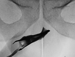 Ngilu! Momen Ahli Kemakmuran Temukan Pinset ‘Nyangkut’ Hingga Mr P Di 4 Tahun