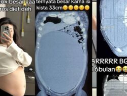 Cerita Wanita Surabaya Idap Kista Sebesar 33 Cm, Awalnya Dikira Perut Kembung