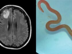 Ngeri, Ahli Kebugaran Temukan Cacing Parasit Ular Piton 8 Cm Di Otak Wanita Australia