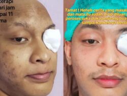 Awal Mula Pria Medan Angkat Bola Mata Sebab Kanker, Ini Gejalanya